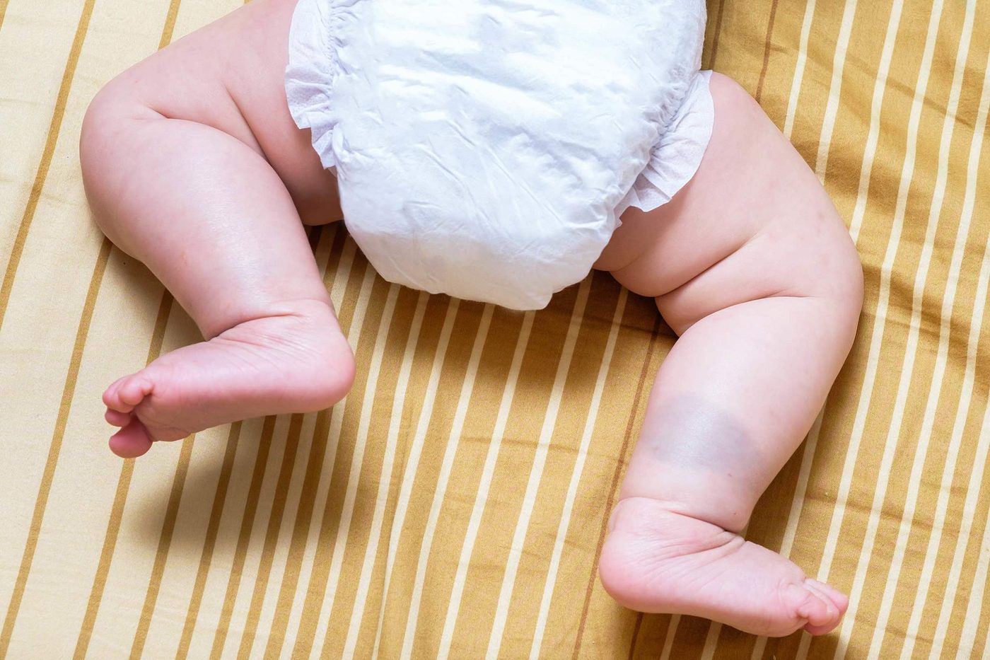 Mancha mongólica: o que é e por que aparece no bebê?
