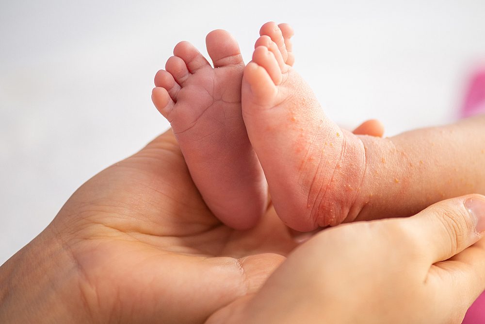 Brotoeja em bebê: o que é e como tratar?