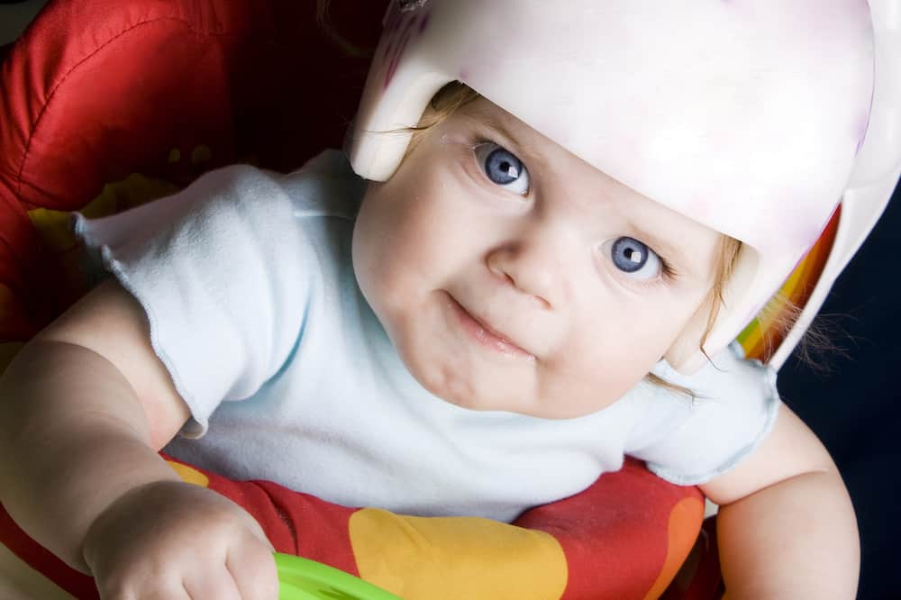 assimetria craniana - plagiocefalia - bebê com capacete